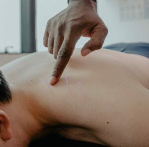 dry needling for nerve pain