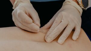 dry needling for neck back shoulder pain physiotherapy tools rehabilitation