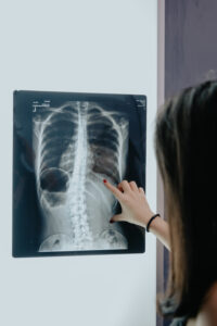 scoliosis x ray