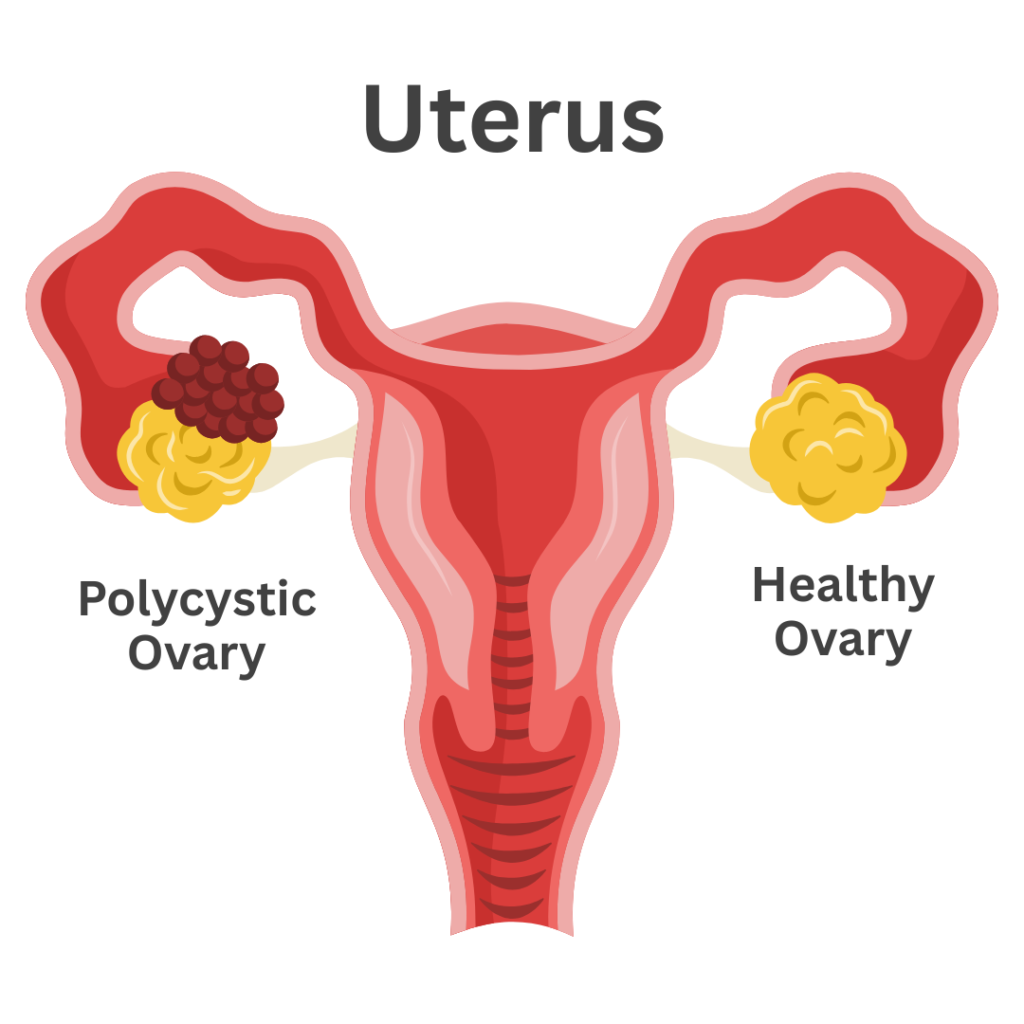 Polycystic Ovary Syndrome (PCOS) is a common hormonal condition that affects many women of reproductive age. Understanding what is PCOS, its causes, symptoms, and management options is essential to maintain overall wellbeing. At City Osteopathy & Physiotherapy, we take a holistic approach, combining lifestyle guidance, nutrition, and professional support to help women navigate the challenges of PCOS.