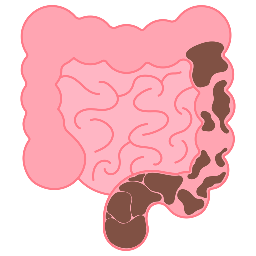 Constipation Relief Through Naturopathy