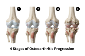 Osteoarthritis Knee Treatment in Singapore
