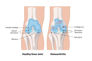 Osteoarthritis Knee Treatment in Singapore