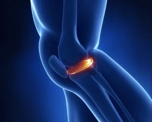 Meniscus Tear in Singapore: Symptoms, Treatments, and Recovery