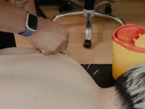 A practitioner tapping a thin dry needling tube against a patient's leg to insert a needle during a therapy session.