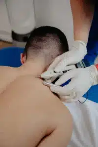 Dry needling treatment targeting muscle tissue